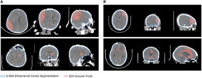 Label-efficient deep semantic segmentation of intracranial hemorrhages in CT-scans